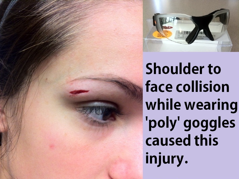 Field hockey injury caused by collision with athlete wearing goggles.